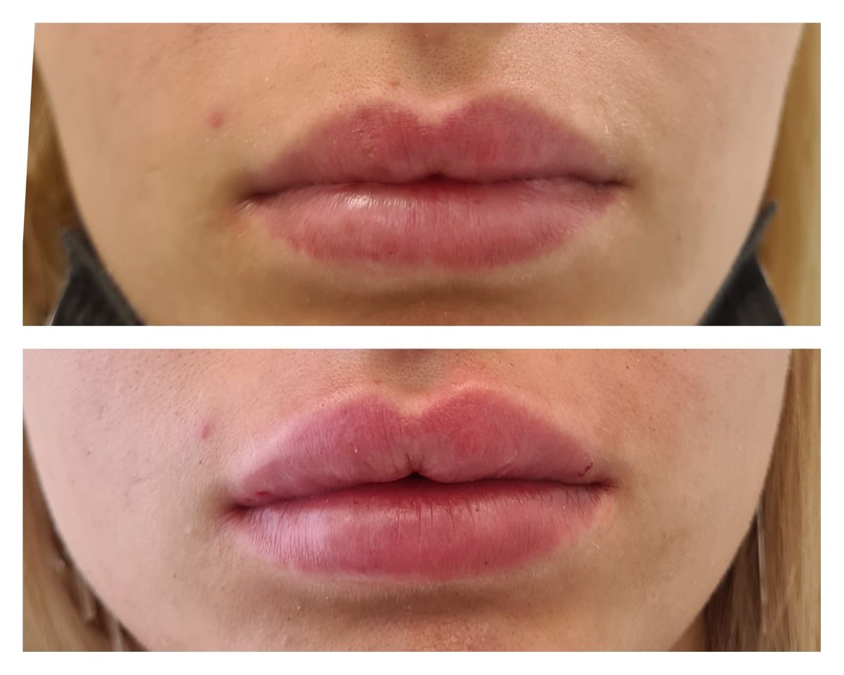 Labbra prima e dopo il trattamento con acido ialuronico