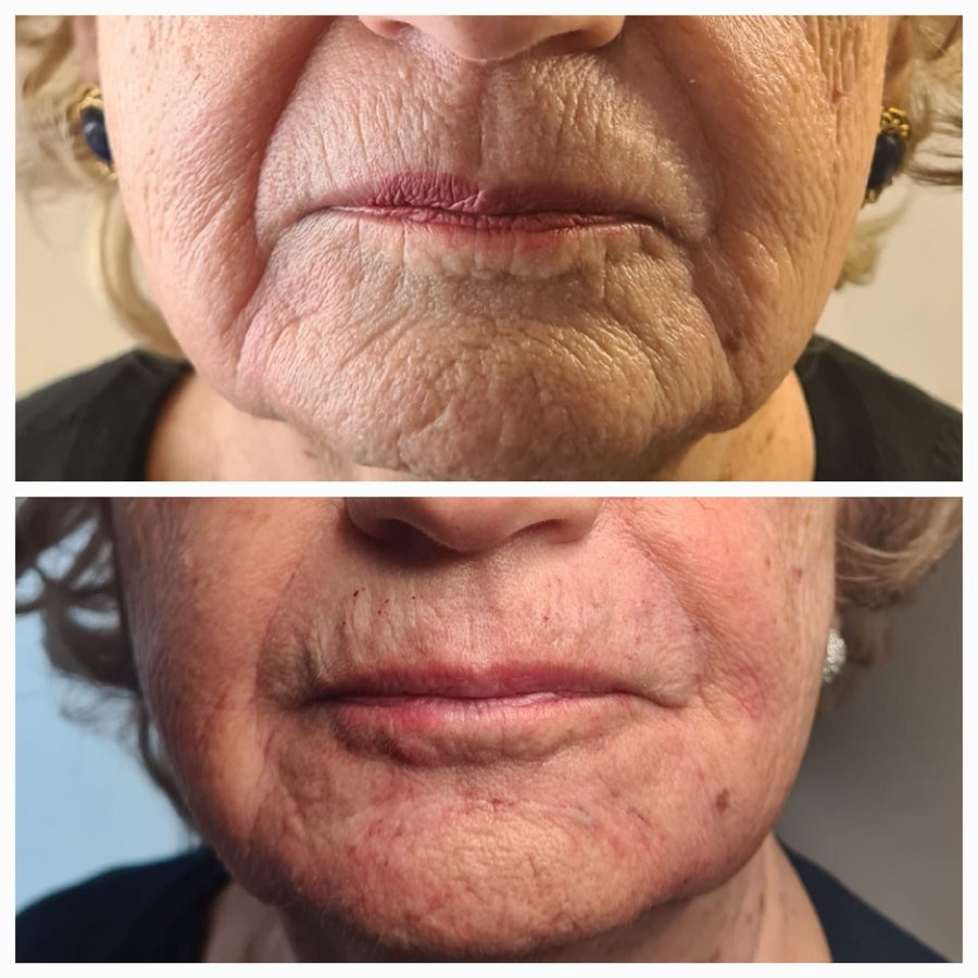 Viso maturo prima e dopo: rughe e qualit&agrave; della pelle