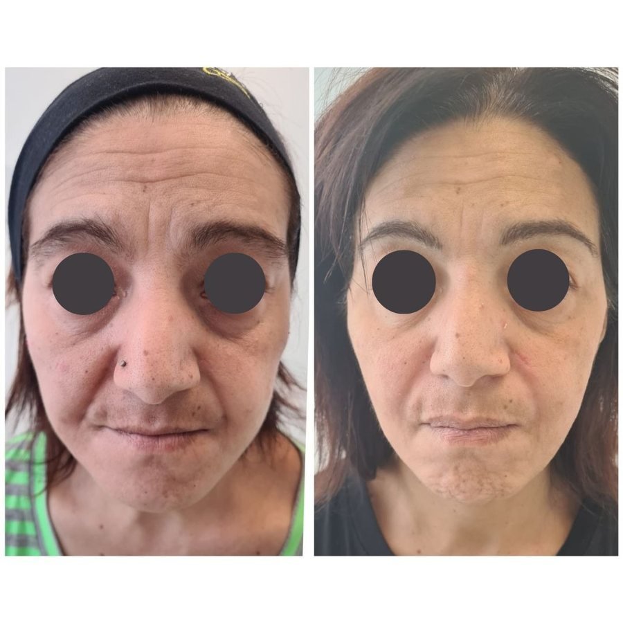 Occhiaie e sguardo stanco: prima e dopo il trattamento