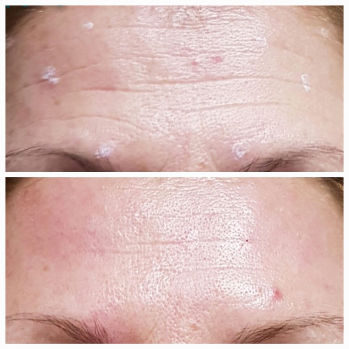 Pelle spenta: texture, pori e rughe sottili prima e dopo il trattamento